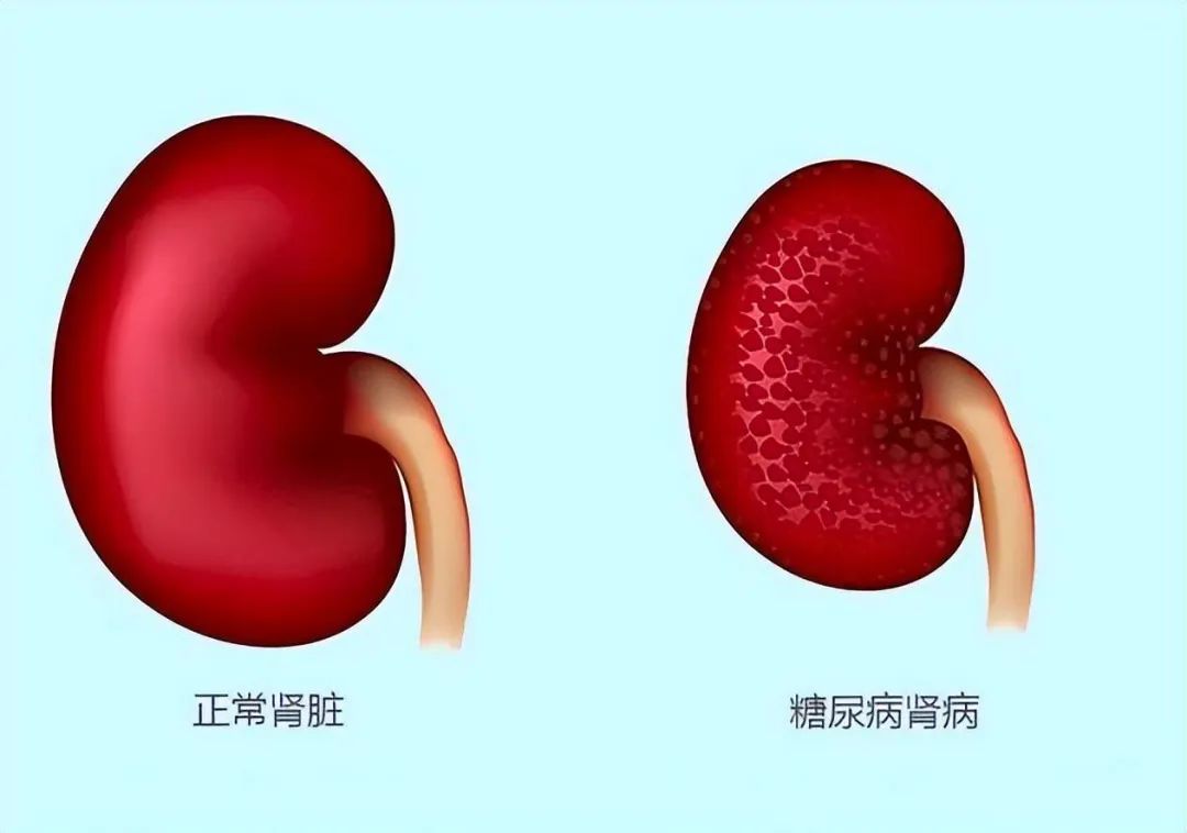 什么是糖尿病肾病？