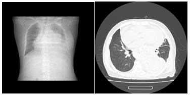 一位长期透析不充分的女性患者