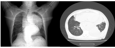 一位尚未透析的终末期肾脏病患者