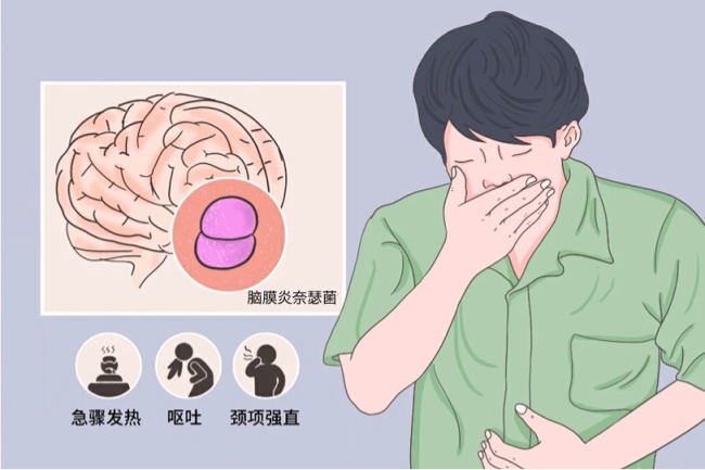 突发高热、呕吐、皮肤瘀斑请及时就医！流脑进入高发季