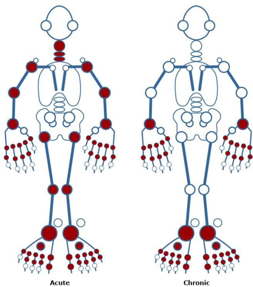 图左：基孔肯雅热急性期手部、脚部小关节、各大关节均会出现持续性剧痛；图右：基孔肯雅热慢性期部分患者小关节会遗留永久关节痛及关节损害