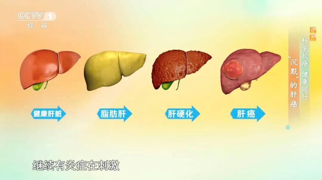 警惕肝脏的“隐形炸弹” 收好这份预防肝癌行动指南