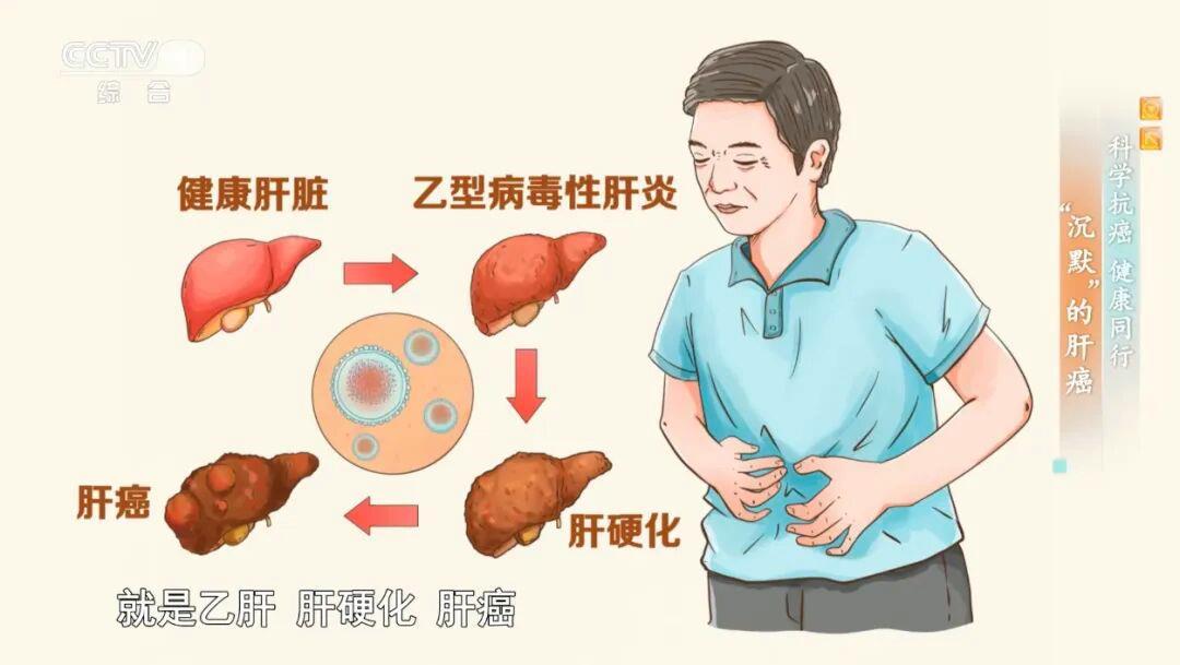 警惕肝脏的“隐形炸弹” 收好这份预防肝癌行动指南