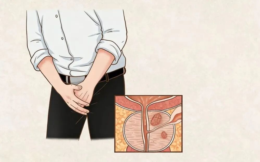 前列腺癌：你了解它吗？